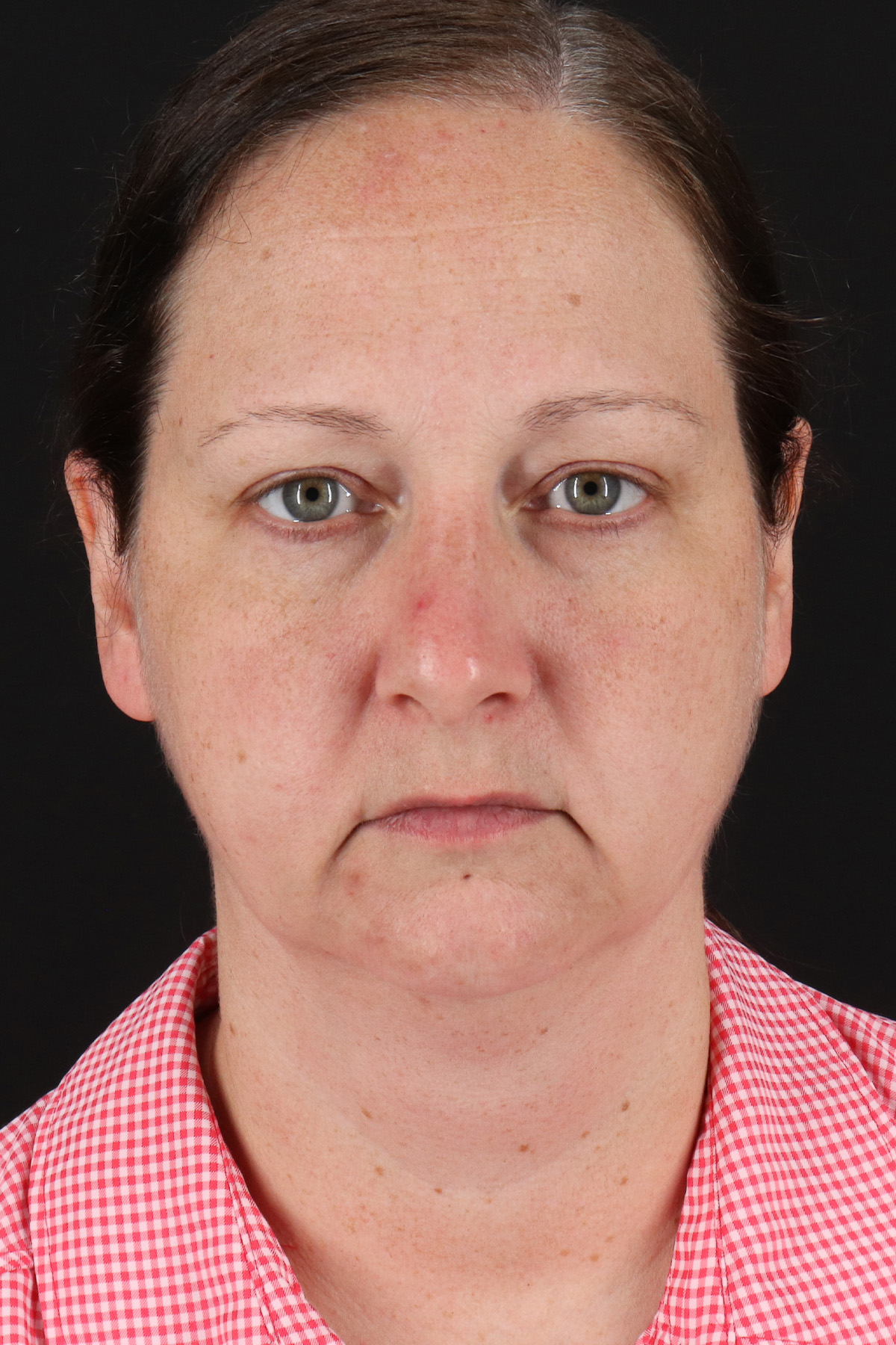 Lower Blepharoplasty Before & After Patient #13052