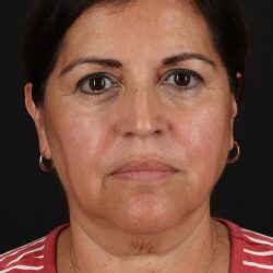 Lower Blepharoplasty Before & After Patient #13063