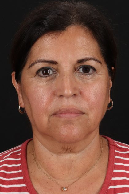 Lower Blepharoplasty Before & After Patient #13063