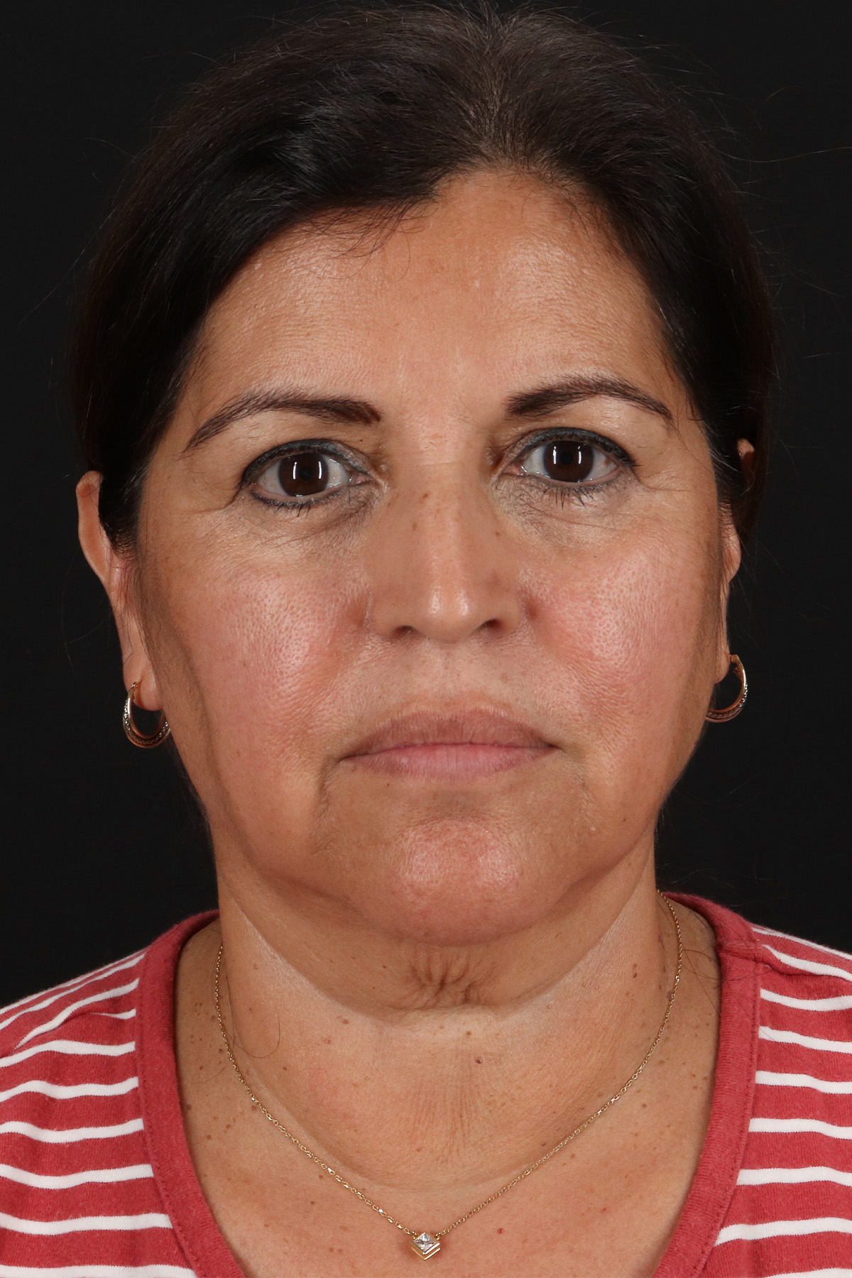Neck Lift Before & After Patient #12909