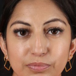 Rhinoplasty Before & After Patient #12458