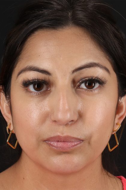 Rhinoplasty Before & After Patient #12458