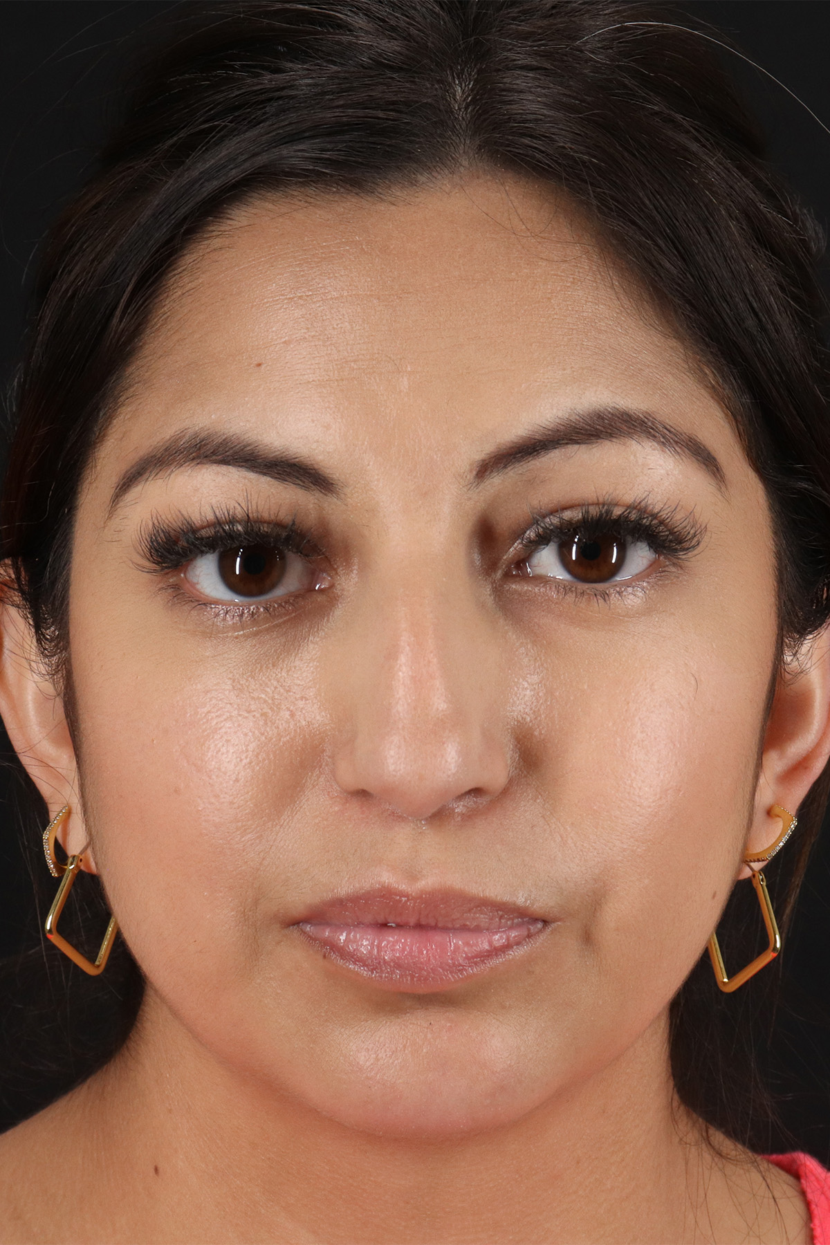 Rhinoplasty Before & After Patient #12458