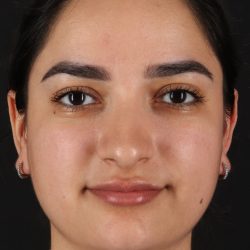 Rhinoplasty Before & After Patient #12436