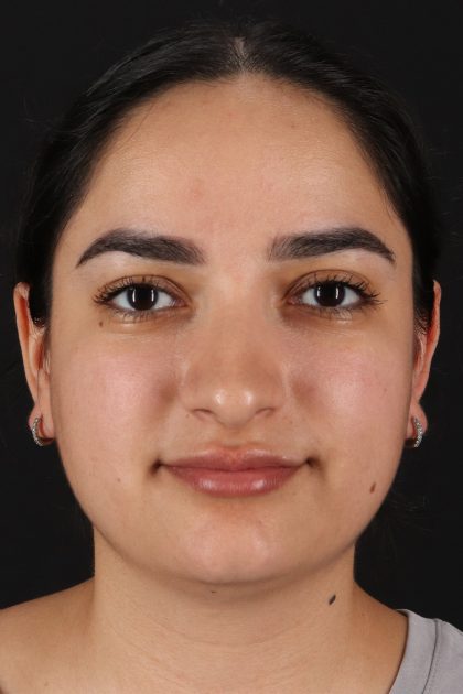Rhinoplasty Before & After Patient #12436