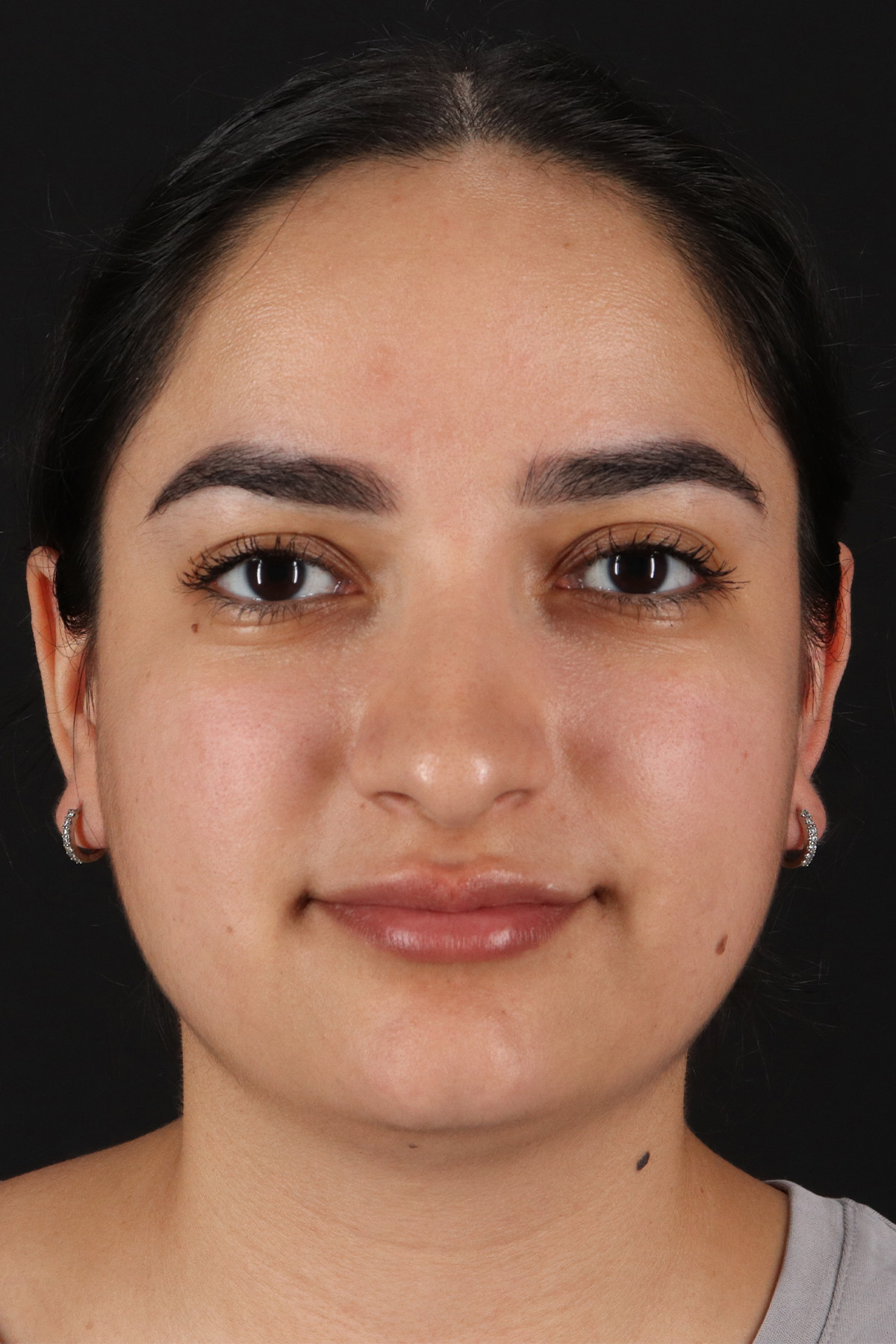 Rhinoplasty Before & After Patient #12436