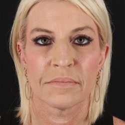 Upper Blepharoplasty Before & After Patient #12095