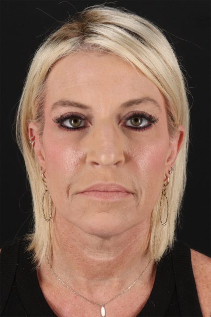 Upper Blepharoplasty Before & After Patient #12095