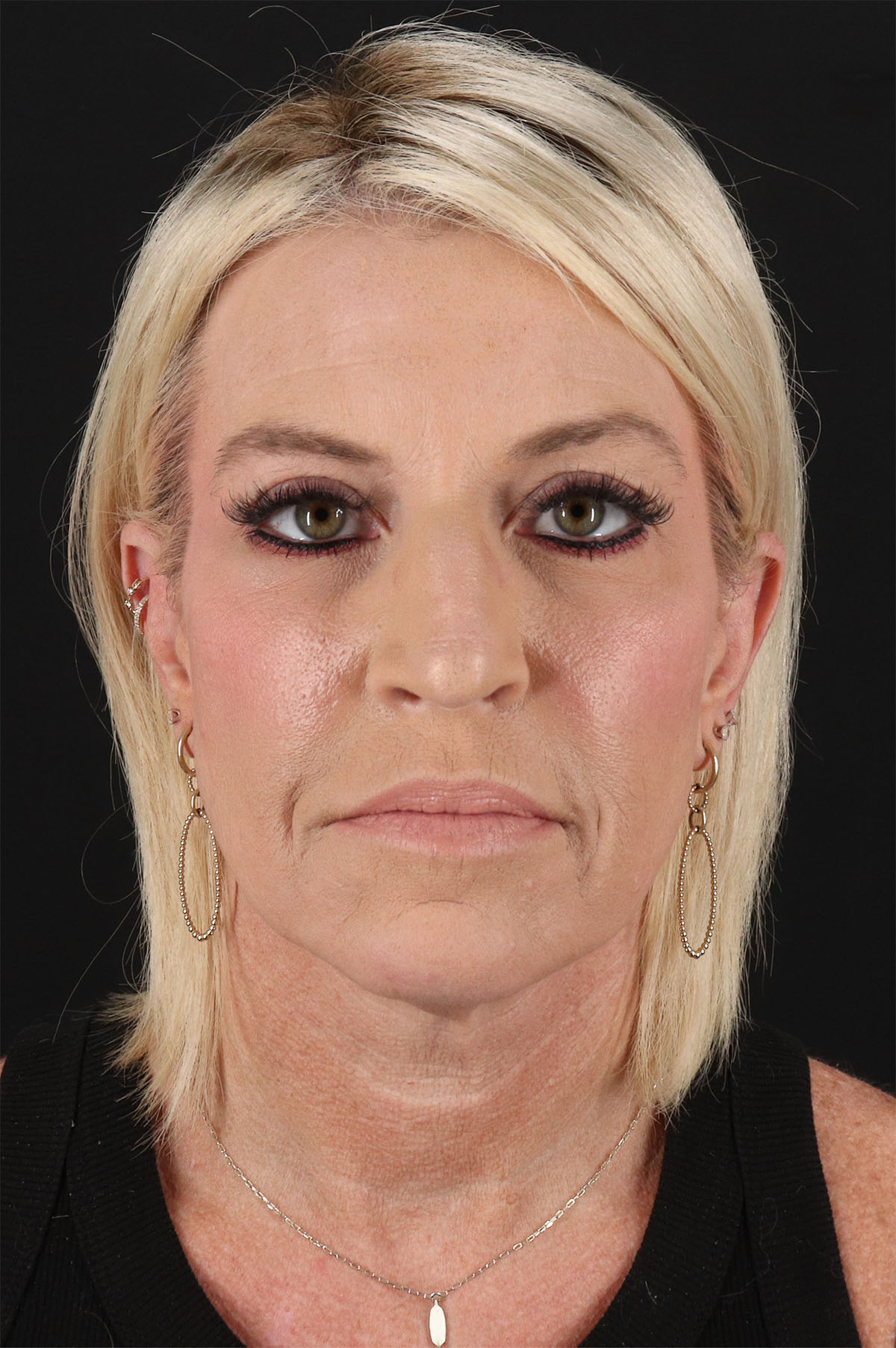 Upper Blepharoplasty Before & After Patient #12095