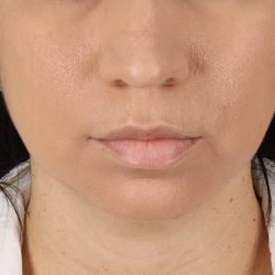 Chin Implant Before & After Patient #13783