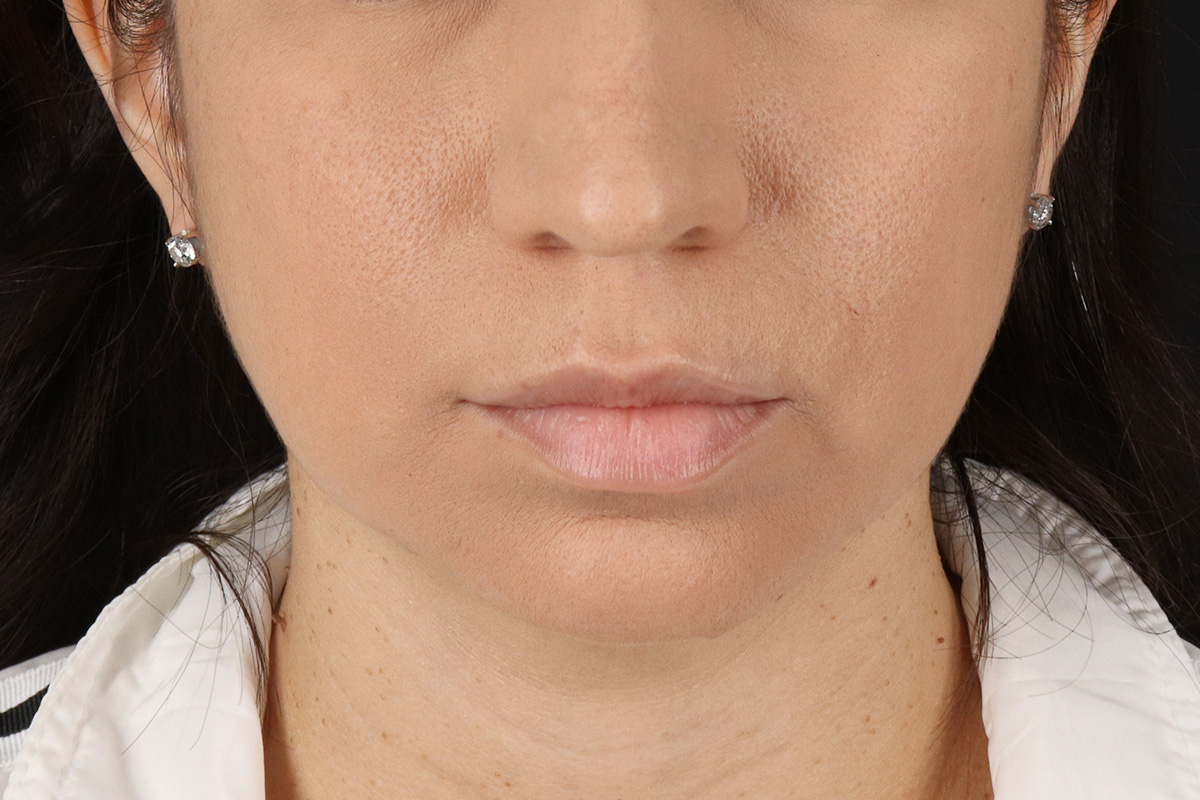 Chin Implant Before & After Patient #13783