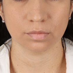 Neck Lift Before & After Patient #14047