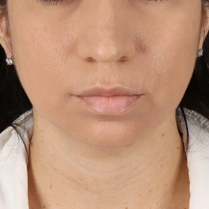 Facelift Before & After Patient #11699