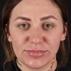 Rhinoplasty Before & After Patient #12403