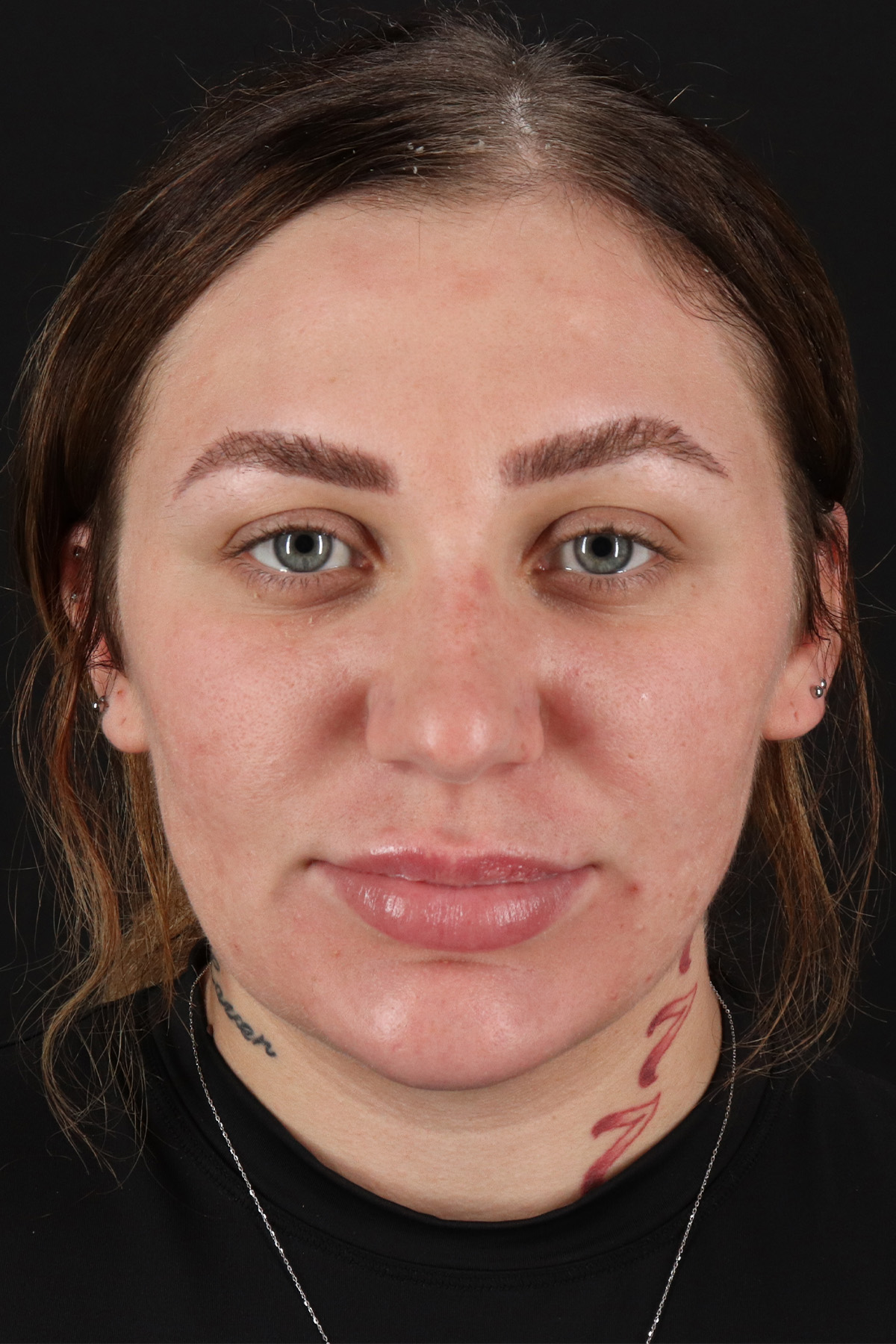 Rhinoplasty Before & After Patient #12403