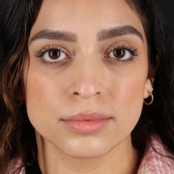 Rhinoplasty Before & After Patient #12249