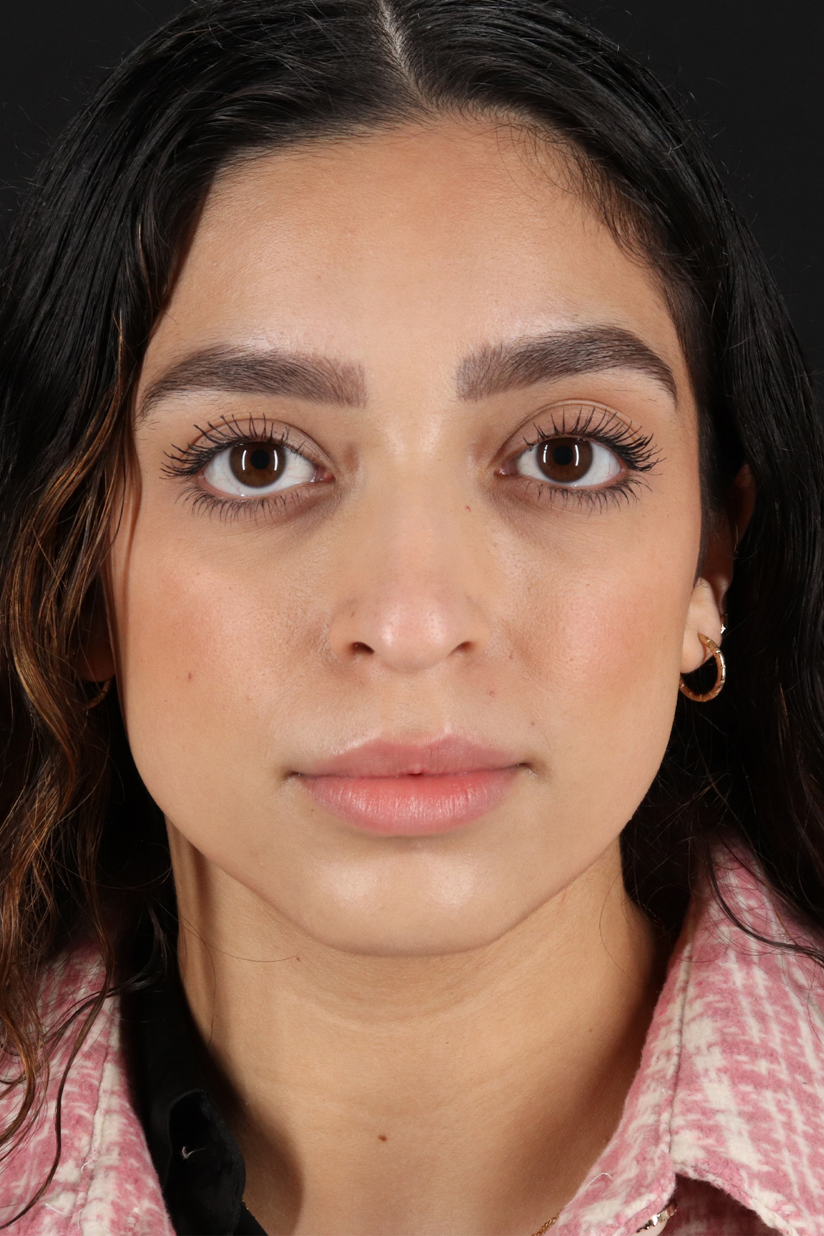 Rhinoplasty Before & After Patient #12249