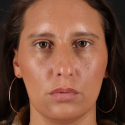 Chin Implant Before & After Patient #13728