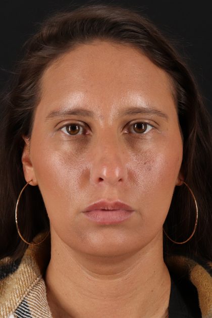 Chin Implant Before & After Patient #13728
