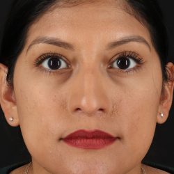 Rhinoplasty Before & After Patient #12337