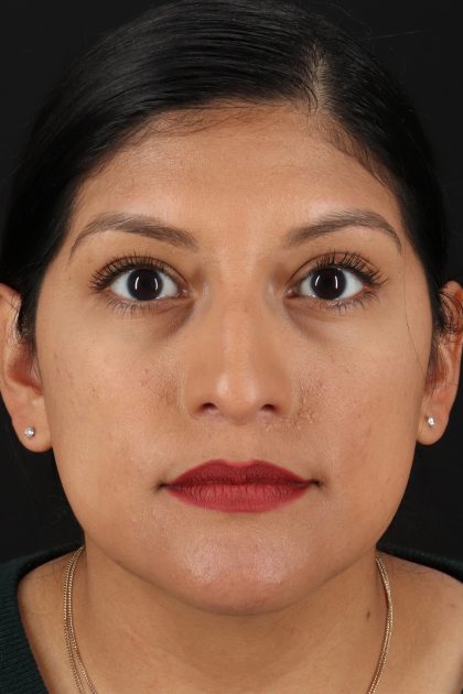 Rhinoplasty Before & After Patient #12337