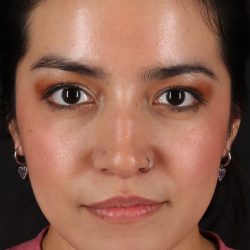 Fillers Before & After Patient #13298