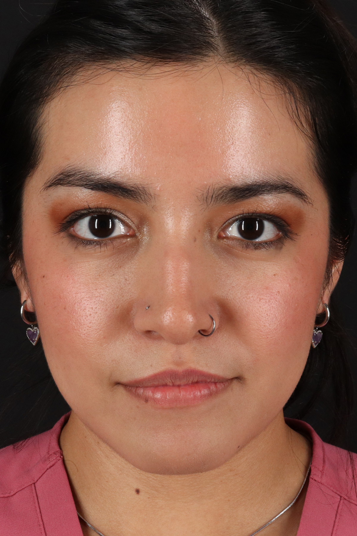 Fillers Before & After Patient #13298
