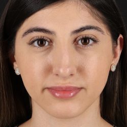 Rhinoplasty Before & After Patient #12304