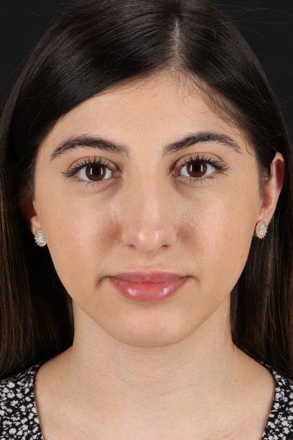 Rhinoplasty Before & After Patient #12304