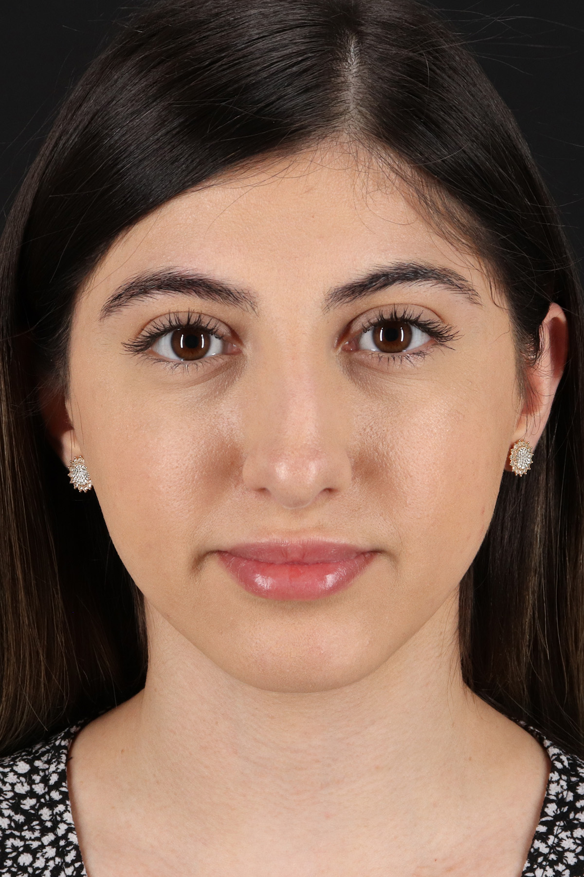 Rhinoplasty Before & After Patient #12304