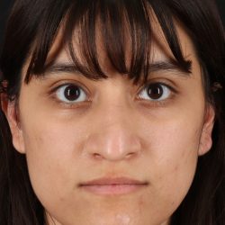 Rhinoplasty Before & After Patient #12469