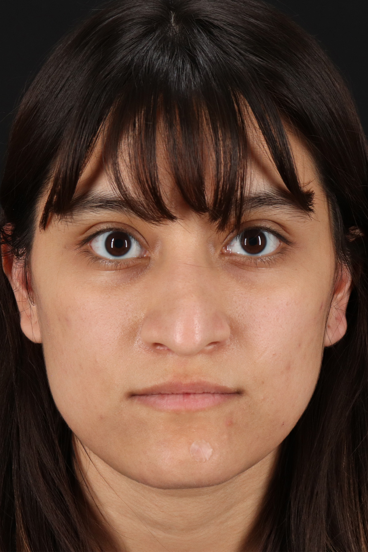 Rhinoplasty Before & After Patient #12469