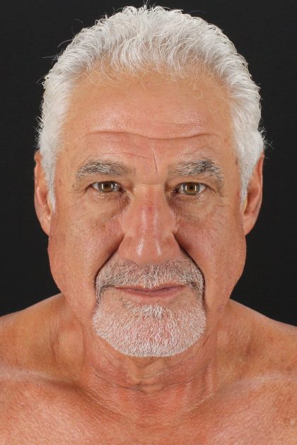 Lower Blepharoplasty Before & After Patient #13096