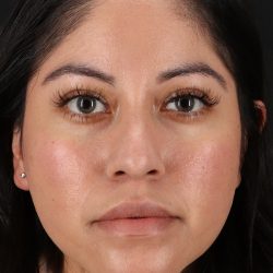 Fillers Before & After Patient #13276