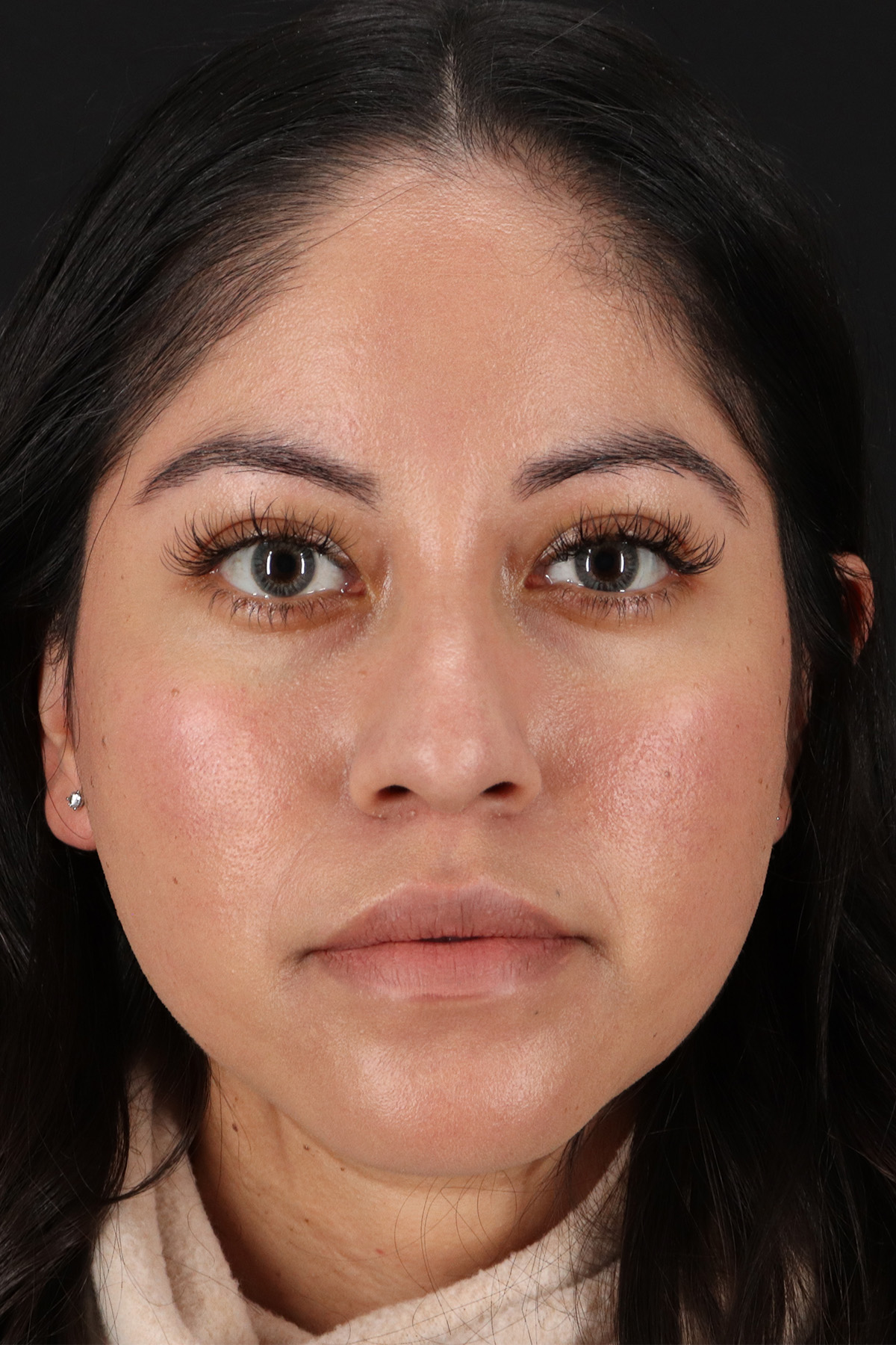Fillers Before & After Patient #13276