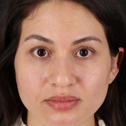 Rhinoplasty Before & After Patient #12282