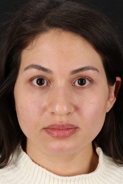 Rhinoplasty Before & After Patient #12282