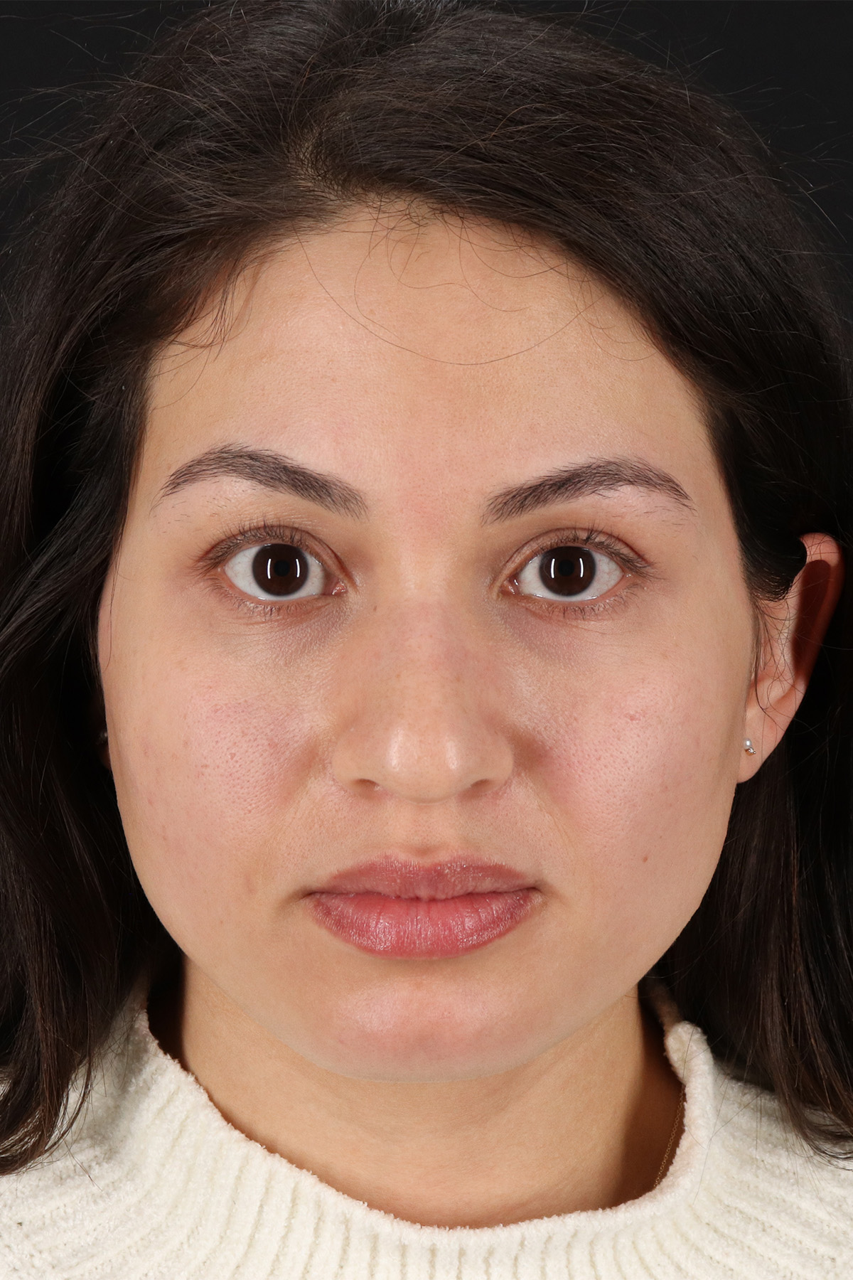 Rhinoplasty Before & After Patient #12282