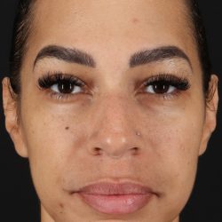 Chin Implant Before & After Patient #11693