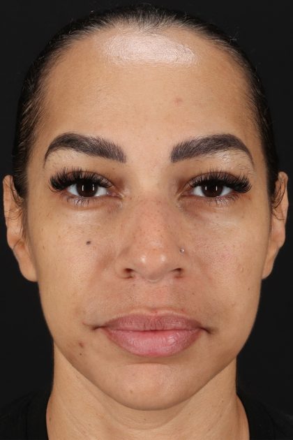 Chin Implant Before & After Patient #11693