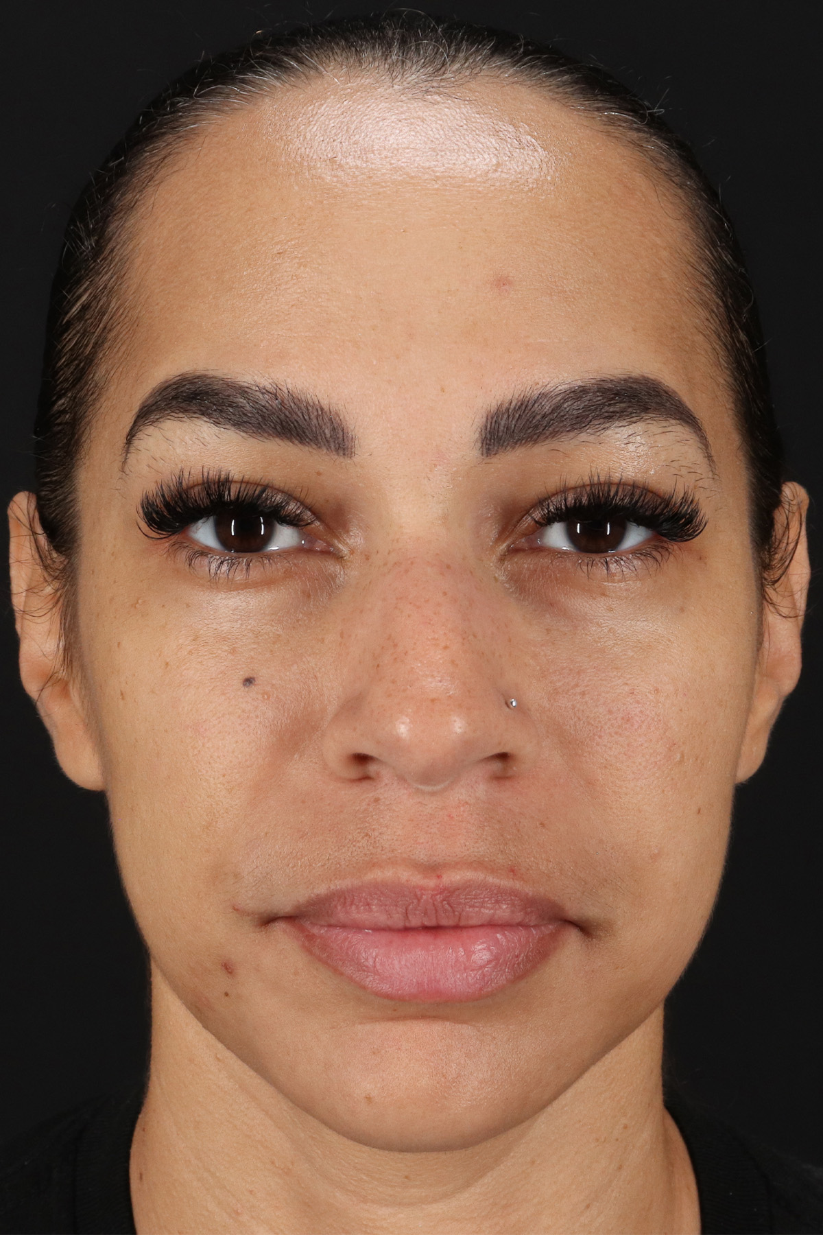 Chin Implant Before & After Patient #11693