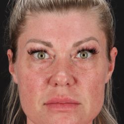Lower Blepharoplasty Before & After Patient #13030