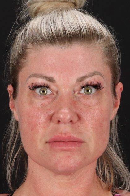 Lower Blepharoplasty Before & After Patient #13030