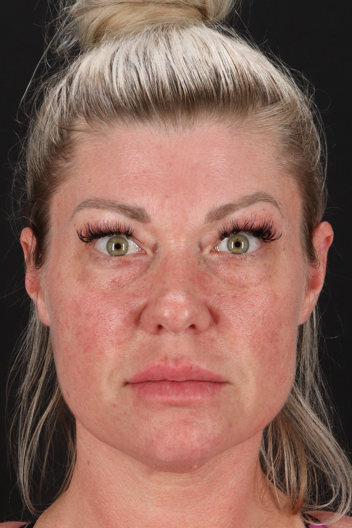 Lower Blepharoplasty Before & After Patient #13030