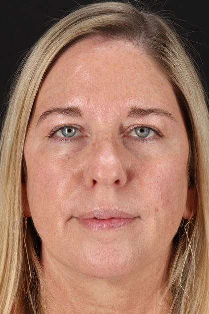 Upper Blepharoplasty Before & After Patient #12029