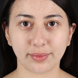 Rhinoplasty Before & After Patient #12359