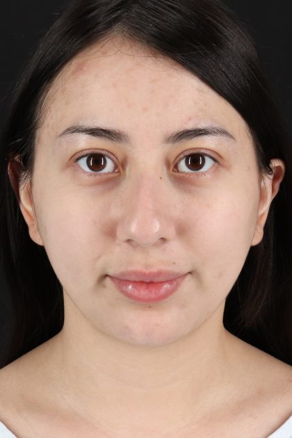 Rhinoplasty Before & After Patient #12359