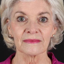 Upper Blepharoplasty Before & After Patient #14036