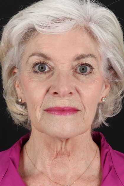 Upper Blepharoplasty Before & After Patient #14036