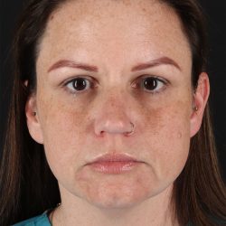 Chemical Peels Before & After Patient #11070